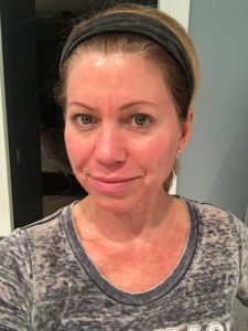 Microneedling before and after photo