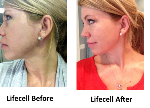 lifecell before and after