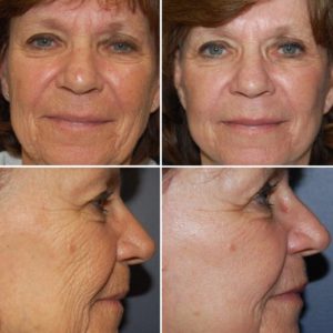 co2 laser resurfacing