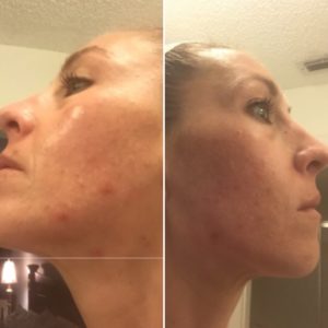 Curology Before and After Photo