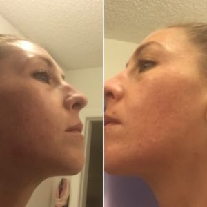Curology Before and After Photo