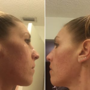 Curology Before and After photo