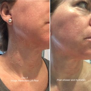 perfection lift peel results
