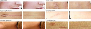 Skinception Dermefface FX7 Scar Reduction Therapy Before and After