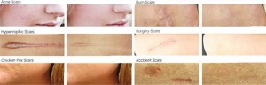 Skinception Dermefface FX7 Scar Reduction Therapy Before and After