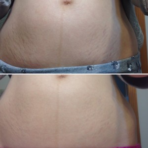 Skinception Intensive Stretch Mark Therapy