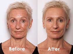 biogeniste and dermal meds before and after