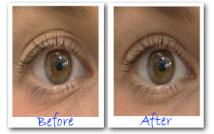 eye secrets before and after