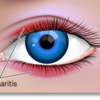 Eye creams for Blepharitis