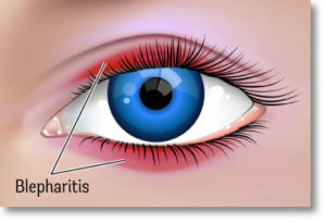 Eye creams for Blepharitis