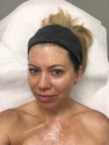 Microneedling before and after photo