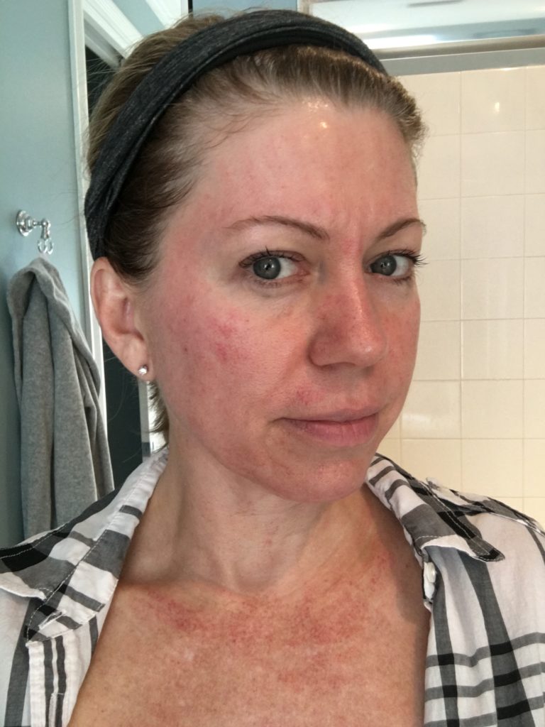 Microneedling Vs Microdermabrasion Vs Dermaplaning Results