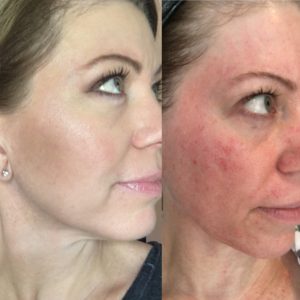 Microneedling before and after photo