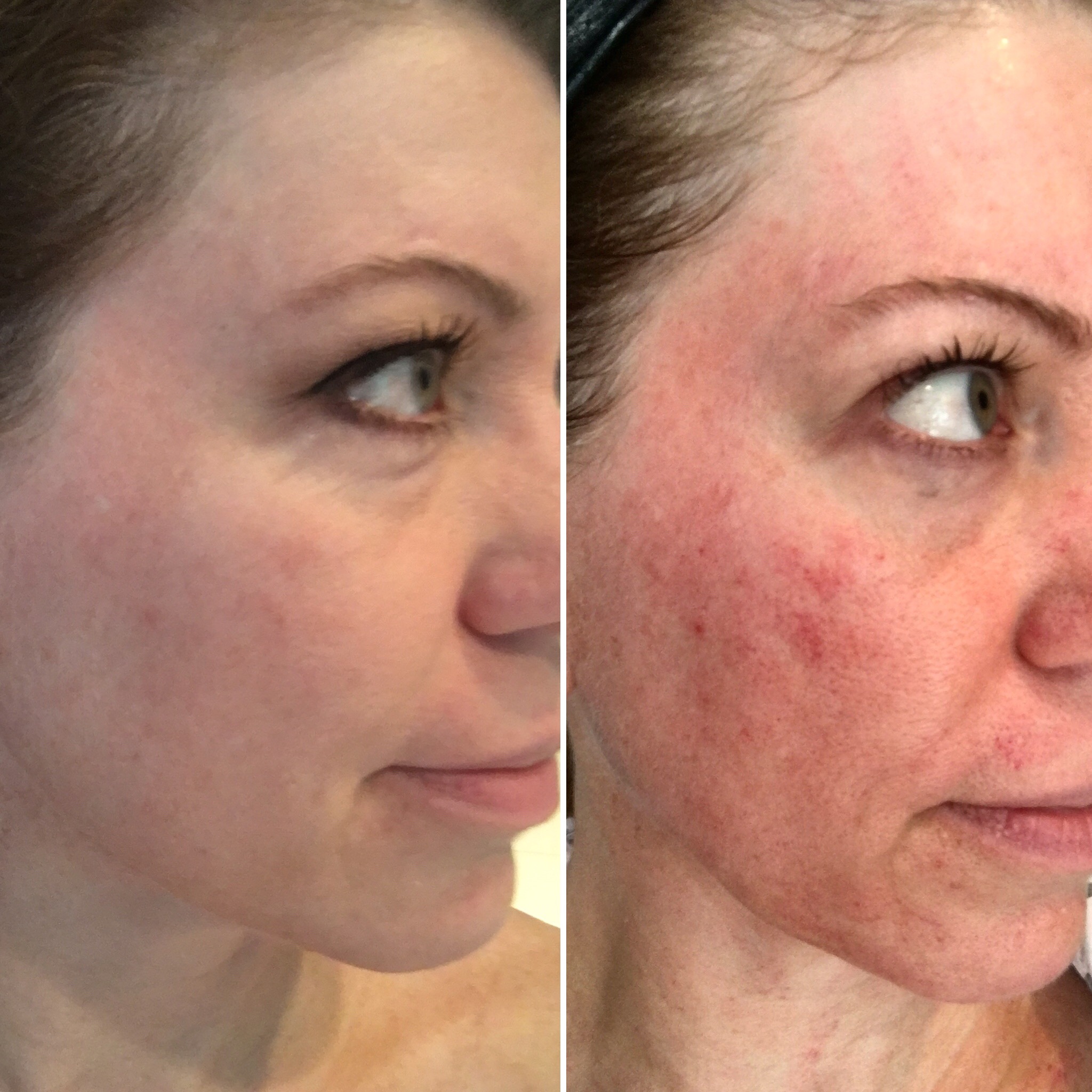 Microneedling results