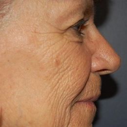 laser resurfacing